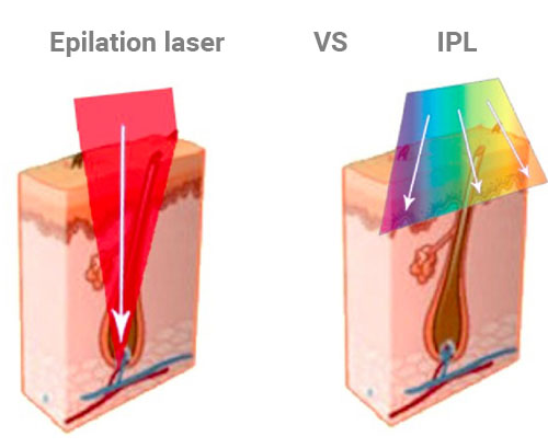 Epilation électrique VS épilation au laser : les différences